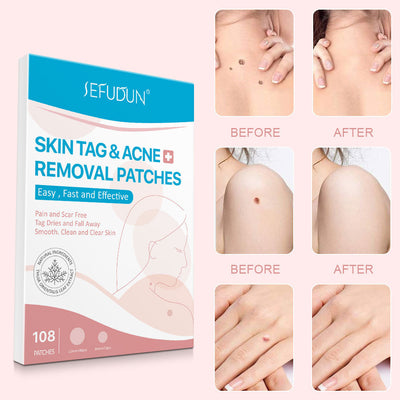 Acne Skin Tag Remover Beauty Acne Patch Wart Removal Stickers Removal Care Invisible Blackhead Skin Patch